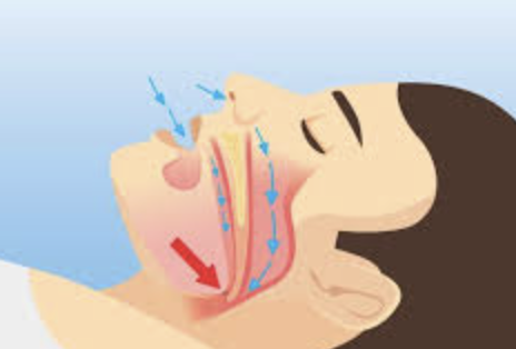 los problemas para dormir más comunes: apnea del sueño